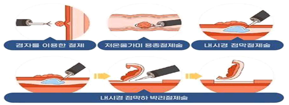 용종 제거 방법